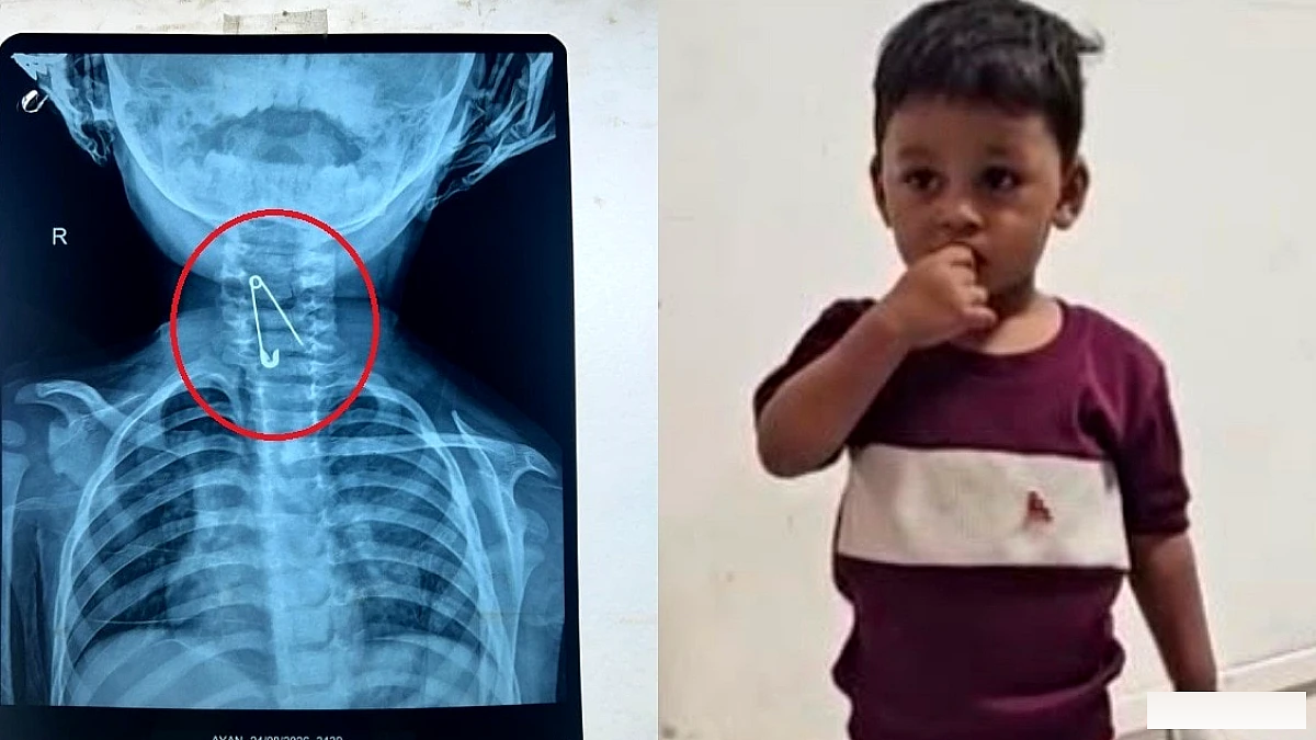 सेफ्टी पिन मुंह में डाली और निगल गया मासूम... डॉक्टरों ने ऐसे बचाई जान