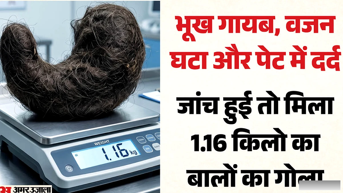 20 साल की लड़की ने 11 साल खाए बाल: पेट में बना 1.16 किलो का गोला, नहीं लगती थी भूख; गिरता गया वजन, ऐसे बची जान